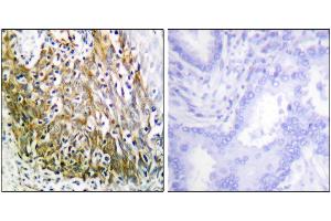 Iunohistochemistry analysis of paraffin-embedded human lung carcinoma tissue using P-10 antibody. (MMP10 Antikörper)