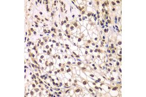 Immunohistochemistry of paraffin-embedded human kidney cancer using SMARCC1 antibody at dilution of 1:200 (400x lens). (SMARCC1 Antikörper)