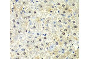 Immunohistochemistry of paraffin-embedded Human liver damage using PSMD13 Polyclonal Antibody at dilution of 1:100 (40x lens).