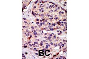 Formalin-fixed and paraffin-embedded human cancer tissue reacted with NPR3 polyclonal antibody  , which was peroxidase-conjugated to the secondary antibody, followed by DAB staining.