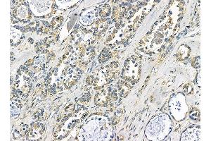 TXNDC6 Antibody at 1/100 staining human ovarian cancer by IHC-P. (NME9 Antikörper)