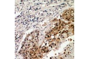 Immunohistochemical analysis of VEGFR3 staining in human lung formalin fixed paraffin embedded tissue section. (FLT4 Antikörper)