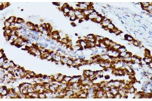 Immunohistochemistry of paraffin-embedded Human thyroid cancer using IDH3A Polyclonal Antibody at dilution of 1:100 (40x lens). (IDH3A Antikörper)