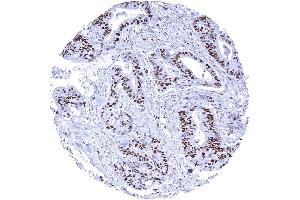 Colorectal adenocarcinoma with a large fraction of MCM7 positive tumor cells (Rekombinanter MCM7 Antikörper  (AA 195-319))