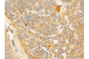 ABIN6259847 and ABIN6277044 at 1/100 staining human ovarian carcinoma by IHC-P. (AK4 Antikörper  (Internal Region))
