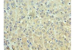 Immunohistochemistry of paraffin-embedded human liver cancer using ABIN7143649 at dilution of 1:100 (ADH1C Antikörper  (AA 1-375))