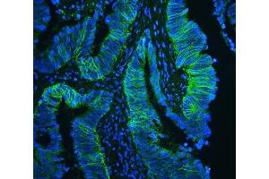 IF analysis of CD147/Emmprin using anti-CD147/Emmprin antibody (ABIN5518743) CD147/Emmprin was detected in paraffin-embedded section of human intestinal cancer tissues. (CD147 Antikörper  (AA 138-323))