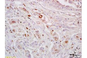 Formalin-fixed and paraffin embedded human lung carcinoma labeled with Rabbit Anti EPH receptor A4 Polyclonal Antibody, Unconjugated (ABIN734123) at 1:200 followed by conjugation to the secondary antibody and DAB staining