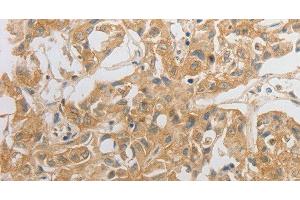 Immunohistochemistry of paraffin-embedded Human lung cancer tissue using HCRTR2 Polyclonal Antibody at dilution 1:50 (HCRTR2 Antikörper)