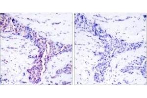 Immunohistochemistry analysis of paraffin-embedded human breast carcinoma tissue, using ATF2 (Ab-73 or 55) Antibody.
