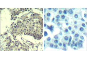 Immunohistochemical analysis of paraffin-embedded human breast carcinoma tissue using mTOR (Ab-2481) Antibody (E021515). (MTOR Antikörper)