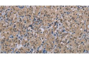 Immunohistochemistry of paraffin-embedded Human thyroid cancer tissue using MGLL Polyclonal Antibody at dilution 1:40 (MGLL Antikörper)