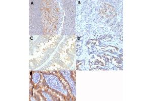 Immunohistochemical staining (Formalin-fixed paraffin-embedded sections) of human tonsil (A), human pancreas (B), human colon carcinoma (C), human rectal carcinoma (D) and human duodenum (E) with ABCC1 monoclonal antibody, clone MRP1/1343 . (ABCC1 Antikörper)