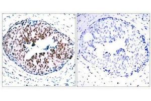 Immunohistochemical analysis of paraffin-embedded human breast carcinoma tissue using STAT5A(Phospho-Ser780) Antibody(left) or the same antibody preincubated with blocking peptide(right). (STAT5A Antikörper  (pSer780))