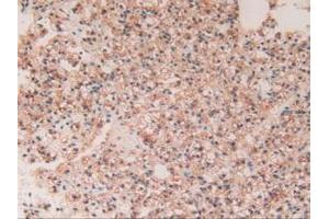 IHC-P analysis of Human Kidney Cancer Tissue, with DAB staining. (GAA Antikörper  (AA 595-770))