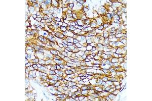 Immunohistochemistry of paraffin-embedded human oophoroma using CD239/BCAM Rabbit mAb (ABIN7265828) at dilution of 1:100 (40x lens). (BCAM Antikörper)