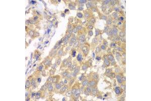 Immunohistochemistry of paraffin-embedded human esophageal cancer using PFKM antibody at dilution of 1:100 (x40 lens).