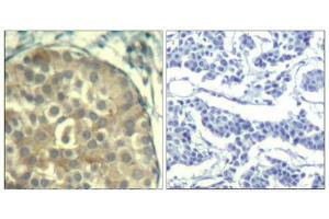 Immunohistochemical analysis of paraffin-embedded human breast carcinoma tissue using cofilin1/cofilin2(Phospho-Tyr88) Antibody(left) or the same antibody preincubated with blocking peptide(right). (Cofilin1/2 (CFL1/2) (pTyr88) Antikörper)