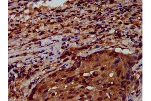 IHC image of ABIN7151198 diluted at 1:600 and staining in paraffin-embedded human lung cancer performed on a Leica BondTM system.