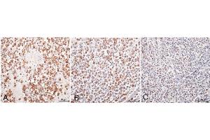 Immunohistochemistry with anti-matrix metalloproteinase 1 (MMP-1) primary antibody with positive reaction visible as brown staining.