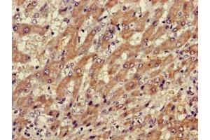 Immunohistochemistry of paraffin-embedded human liver cancer using ABIN7175883 at dilution of 1:100 (XBP1 Antikörper  (AA 1-167))