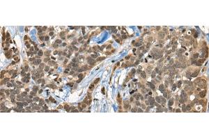 Immunohistochemistry of paraffin-embedded Human thyroid cancer tissue using CBFA2T3 Polyclonal Antibody at dilution of 1:45(x200) (CBFA2T3 Antikörper)