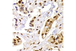 Immunohistochemistry of paraffin-embedded human breast cancer using HNRNPA1 Antibody (ABIN5975570) at dilution of 1/100 (40x lens). (HNRNPA1 Antikörper)