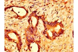 IHC image of ABIN7164465 diluted at 1:500 and staining in paraffin-embedded human colon cancer performed on a Leica BondTM system. (GPR158 Antikörper  (AA 882-1003))