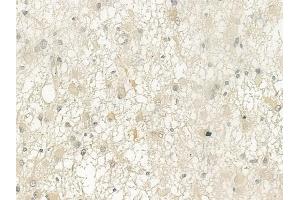 ABIN6265360 and ABIN6276804 at 1/100 staining human astrocytoma by IHC-P.