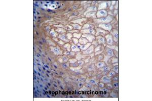 CDCA8 Antibody (N-term) (ABIN656687 and ABIN2845924) immunohistochemistry analysis in formalin fixed and paraffin embedded human esophageal carcinoma followed by peroxidase conjugation of the secondary antibody and DAB staining. (CDCA8 Antikörper  (N-Term))