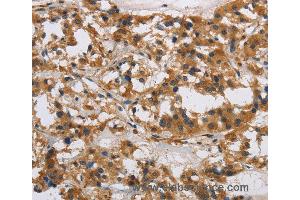 Immunohistochemistry of Human gastric cancer using IL17RB Polyclonal Antibody at dilution of 1:40 (IL17 Receptor B Antikörper)