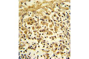 Formalin-fixed and paraffin-embedded human lymph reacted with ENO1 Antibody (Center), which was peroxidase-conjugated to the secondary antibody, followed by DAB staining. (ENO1 Antikörper  (AA 178-205))