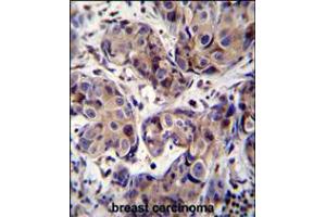 MAGEA3 Antibody immunohistochemistry analysis in formalin fixed and paraffin embedded human breast carcinoma followed by peroxidase conjugation of the secondary antibody and DAB staining. (MAGEA3 Antikörper  (C-Term))