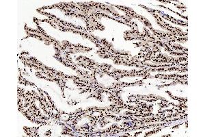 Immunohistochemistry analysis of paraffin-embedded human stomach cancer using c-Fos Polyclonal Antibody at dilution of 1:200. (c-FOS Antikörper)