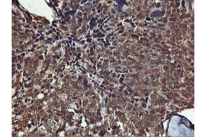 Immunohistochemical staining of paraffin-embedded Adenocarcinoma of Human breast tissue using anti-AKT1 mouse monoclonal antibody. (AKT1 Antikörper)