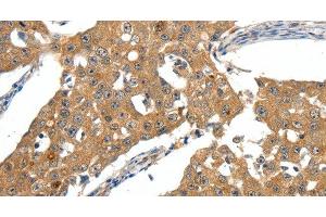 Immunohistochemistry of paraffin-embedded Human breast cancer tissue using SCN5A Polyclonal Antibody at dilution 1:30 (SCN5A Antikörper)