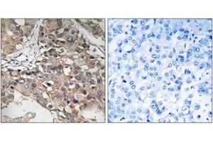 Immunohistochemistry analysis of paraffin-embedded human breast carcinoma tissue, using MAP3K7 (Ab-187) Antibody. (MAP3K7 Antikörper  (AA 161-210))