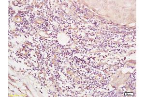 Formalin-fixed and paraffin embedded human breast carcinoma tissue labeled with Anti SGK3 Polyclonal Antibody,Unconjugated (ABIN1387590) at 1:200 followed by conjugation to the secondary antibody and DAB staining. (SGK3 Antikörper  (AA 40-90))