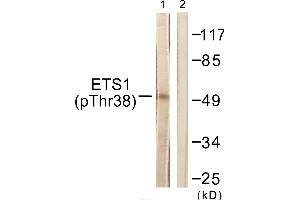 Immunohistochemistry analysis of paraffin-embedded human breast carcinoma tissue using ETS1 (Phospho-Thr38) antibody. (ETS1 Antikörper  (pThr38))