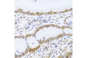 Immunohistochemistry of paraffin-embedded human gastric cancer using MCM4 Antibody (ABIN5971548) at dilution of 1/100 (40x lens). (MCM4 Antikörper)