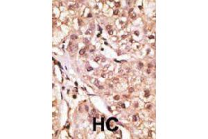 Formalin-fixed and paraffin-embedded human hepatocellular carcinoma tissue reacted with IL29 polyclonal antibody  , which was peroxidase-conjugated to the secondary antibody, followed by DAB staining. (IL29 Antikörper  (Internal Region))