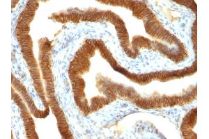 Formalin-fixed, paraffin-embedded human Colon Carcinoma stained with Ep-CAM Mouse Monoclonal Antibody (VU-1D9). (EpCAM Antikörper)