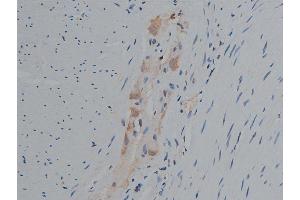 ABIN6267420 at 1/50 staining human colon carcinoma tissue sections by IHC-P. (Phospholipase C gamma 1 Antikörper  (pTyr771))