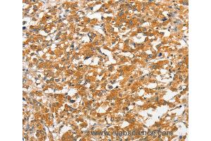 Immunohistochemistry of Human gastric cancer using ANKMY2 Polyclonal Antibody at dilution of 1:30