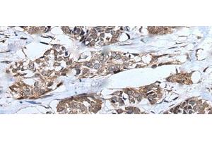 Immunohistochemistry of paraffin-embedded Human esophagus cancer tissue using UBE4B Polyclonal Antibody at dilution of 1:40(x200)