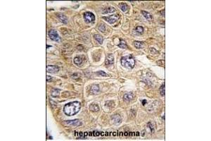 Formalin-fixed and paraffin-embedded human hepatocarcinoma tissue reacted with FDFT1 Antibody (Center) (ABIN389052 and ABIN2839261) , which was peroxidase-conjugated to the secondary antibody, followed by DAB staining. (FDFT1 Antikörper  (AA 140-170))