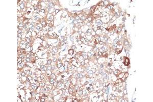 Immunohistochemistry of paraffin-embedded Human liver cancer using SLAMF7 Polyclonal Antibody at dilution of 1:100 (40x lens). (SLAMF7 Antikörper)