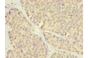 Immunohistochemistry of paraffin-embedded human gastric cancer using ABIN7175622 at dilution of 1:100 (LRRC8E Antikörper  (AA 353-630))