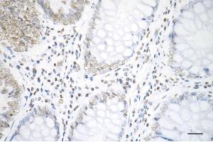 Immunohistochemistry was performed on paraffin-embedded human sigmoid colon carcinoma using histone H3 (acetyl K19) antibody (ABIN7798970), 1:200). (Rekombinanter Histone 3 Antikörper  (H3K18ac))