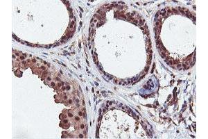 Immunohistochemical staining of paraffin-embedded Human breast tissue using anti-DUSP23 mouse monoclonal antibody. (DUSP23 Antikörper)